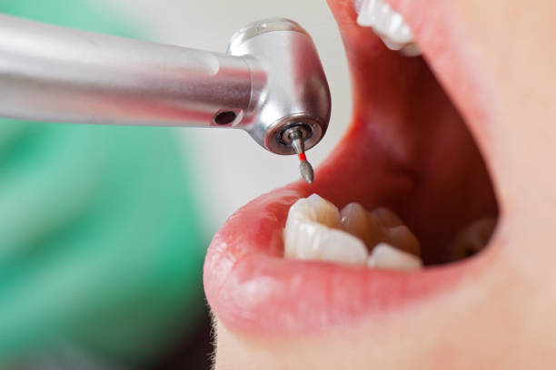 Best Dental Abscess Treatment in Waco, TX